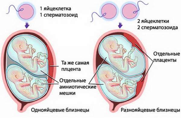 Антенатальная гибель плода при многоплодной беременности