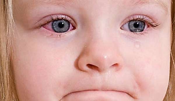 Многие дети из-за аллергии страдают от конъюнктивита.
