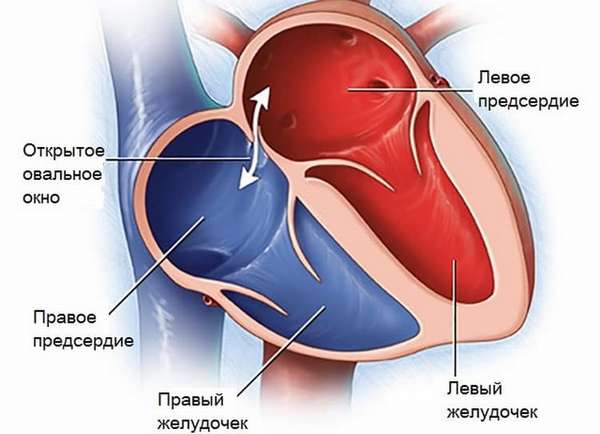Открытое овальное окно в сердце у новорожденного не считается серьезной патологией, поскольку в большинстве случаев к пяти годам но все-таки зарастает.