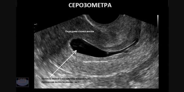 Что такое серометра матки лечение серозометрия