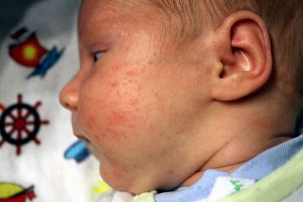 Что делать если аллергия у новорожденного на лице