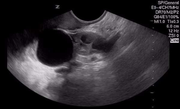 Как выглядит параовариальная киста яичника на снимке УЗИ