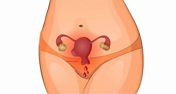 Из-за чего могут возникнуть кровянистые выделения после осмотра гинеколога при беременности