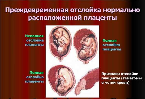 Что такое отслойка плаценты при беременности, как это выглядит и происходит