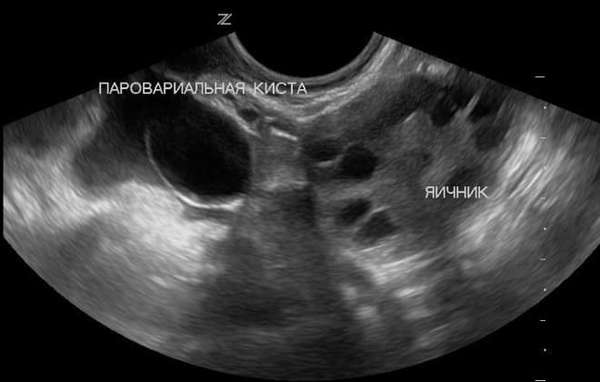 Параовариальная киста при беременности на УЗИ справа