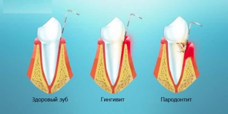 Почему возникают осложнения при кривых зубах