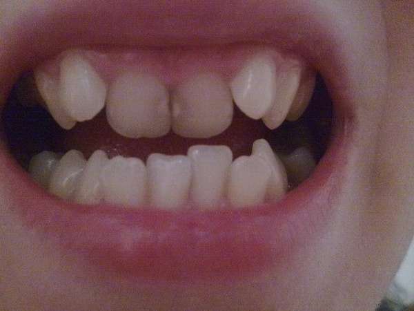 Все о том почему у ребенка растут кривые зубы