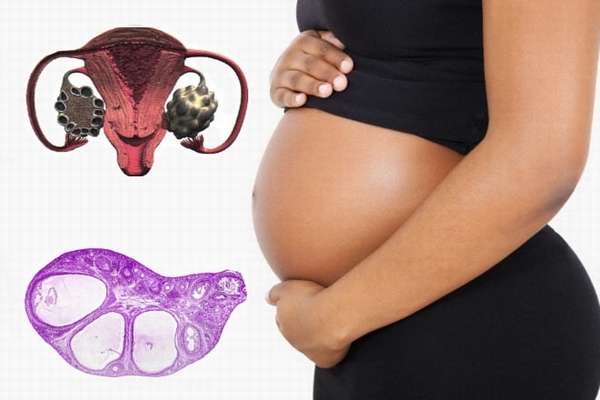 Как избавиться от поликистоза яичников во время беременности