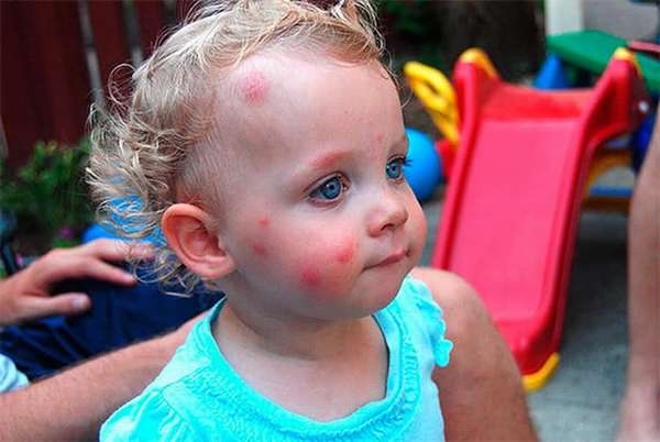 Как выглядит аллергия на укусы комаров у детей, фото