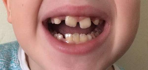 Кривые зубы у детей: причины, выравнивание, фото