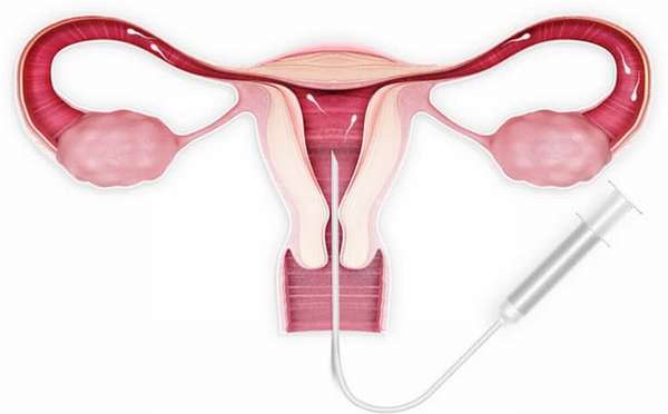Как проходит внутриматочная инсеминация спермой