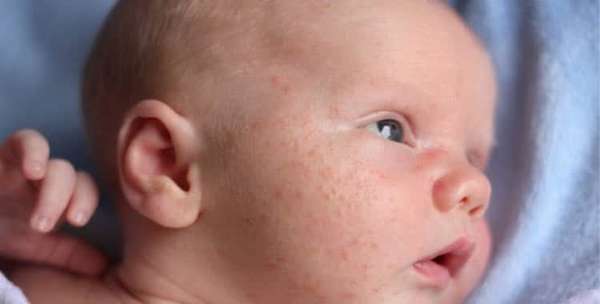 Линекс для новорожденных при коликах: отзывы 