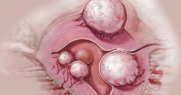Лечение двухкамерной кисты яичника симптомы патологии