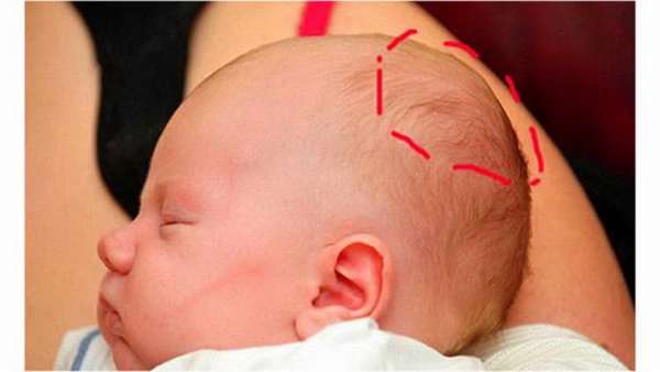 причины возникновения кефалогематомы у новорожденных на голове 