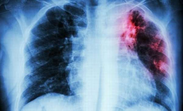 Туберкулёз как прчина появления атрофии яичников