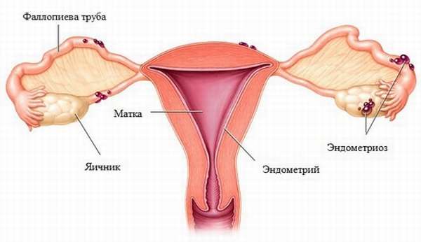 Как выглядит эндометриоз матки и яичников у женщины