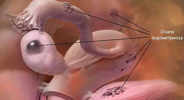 Как выглядит эндометриоз яичников и матки