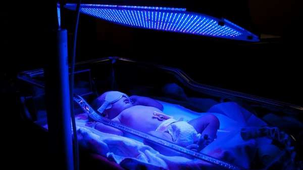 Лечение гемолитической болезни новорожденных часто включает фототерапию.
