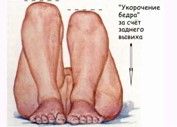Если сложить ножки ребенка вместе и согнуть в коленях, при дисплазии можно заметить, что одно колено будет чуть ниже другого.