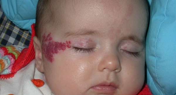 почему возникает гемангиома на лице у ребенка