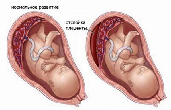 Желто-коричневые выделения при беременности могут говорить об отслойке плаценты.