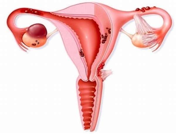 Эндометриоидная киста яичника при беременности
