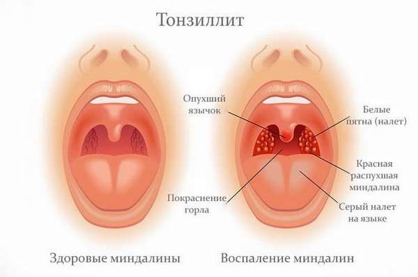 Все о том чем лечить горло при грудном вскармливании