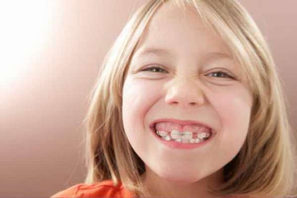 Зачем носят пластины для зубов для детей