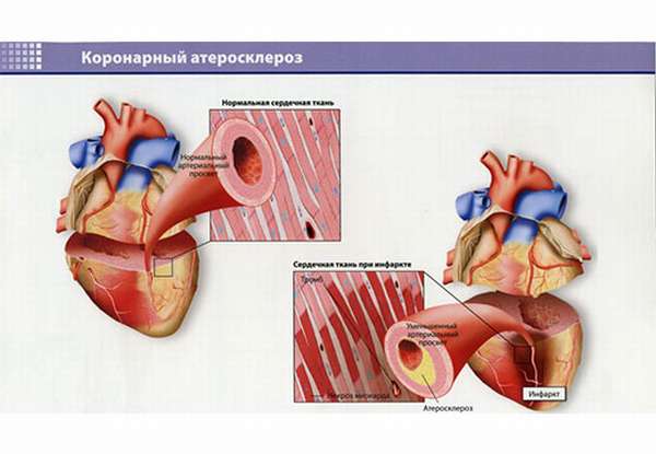 Аорта коронарных артерий