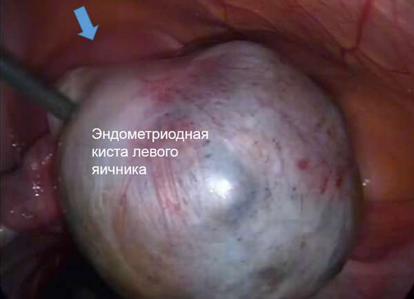 Кистома яичников больших размеров необходимость операции