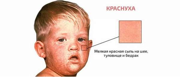 основные симптомы краснухи у детей и как выглядит сыпь на фото
