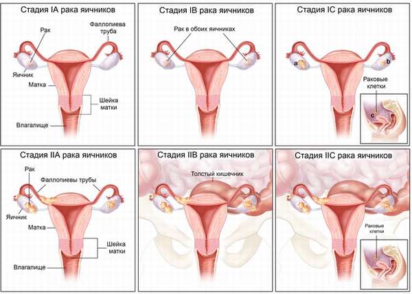 Признаки рака яичников у женщин и первые симптомы заболевания