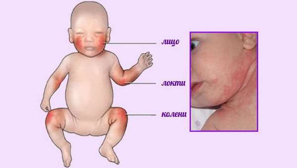 основные причины возникновения атопического дерматита у детей