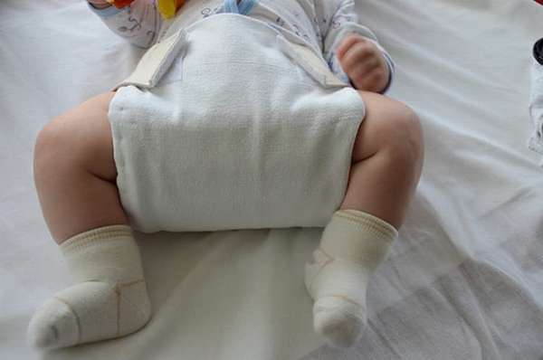 Для профилактики такого состояния суставов ребенка можно практиковать широкое пеленание.