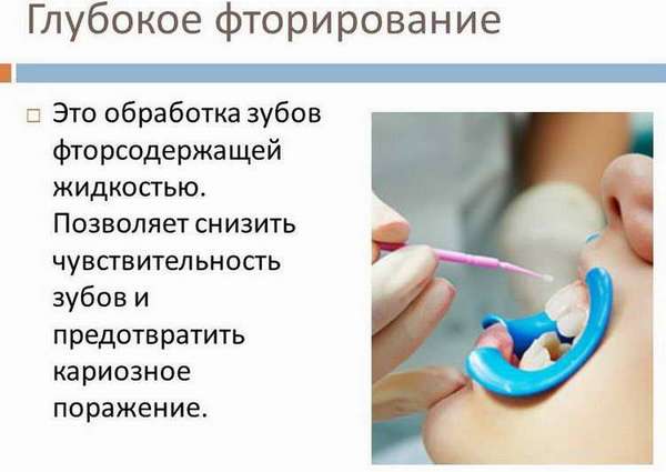 Отличие глубокого фторирования зубов у детей от фторирования гель-лаком