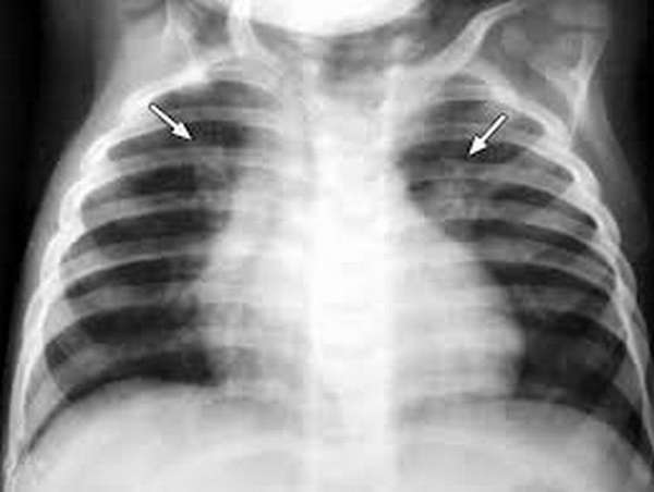 Обычно при подозрении на такой диагноз врач назначает ребенку рентген.