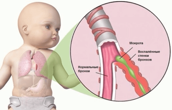 Восстановить иммунитет после пневмонии у ребенка thumbnail