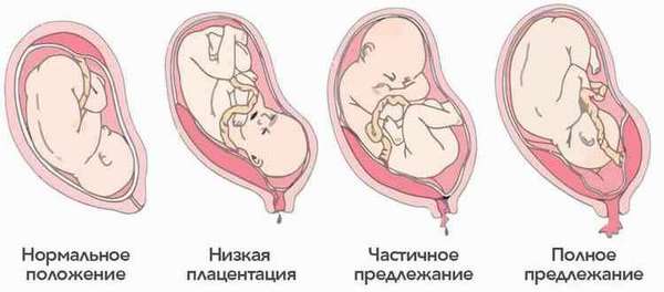В списке показаний к кесареву сечению при беременности также предлежание плаценты.