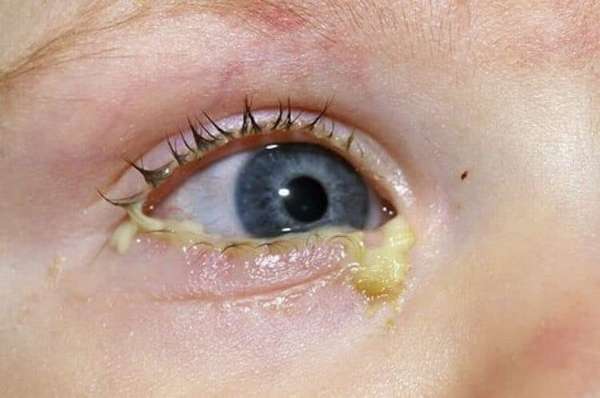Если бактерия попала в глаза, скорее всего она вызовет гнойный конъюнктивит.