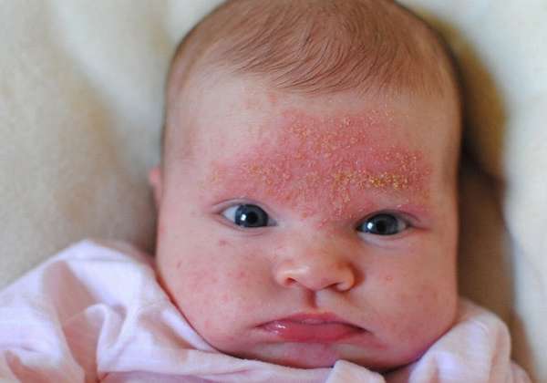 Если у грудничка краснеет и шелушится кожа на лице, скорее всего это аллергия.