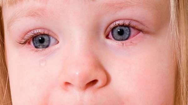 Конъюнктивит у ребенка может развиться из-за вирусов, бактерий или аллергии.