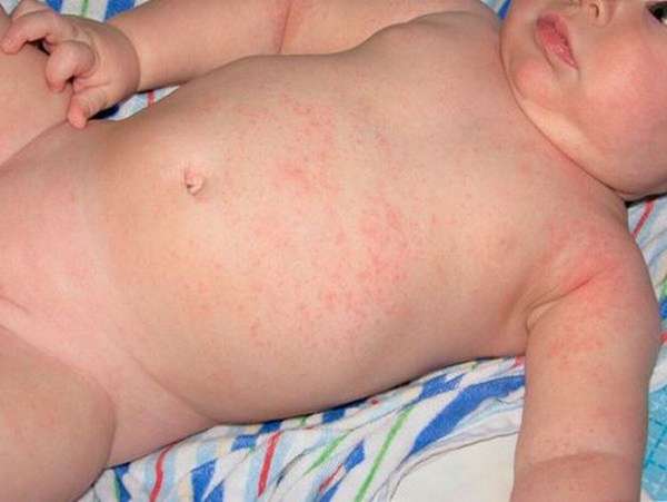 Пищевая аллергия у ребенка в 1 год может проявляться в виде крапивницы.