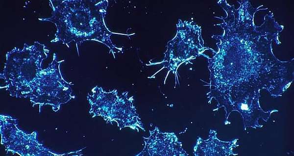 Фото клеток рака яичников на 3 стадии
