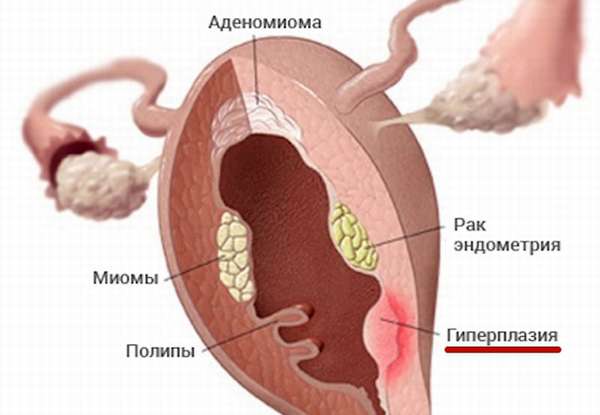Признаки гиперпластического процесса эндометрия смешанная форма
