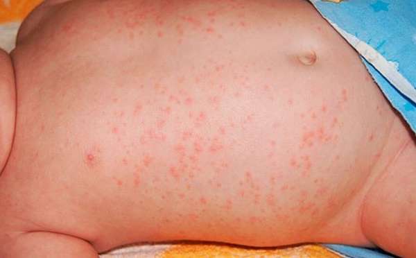 От аллергии на коже врач может назначить крем или мазь для детей.