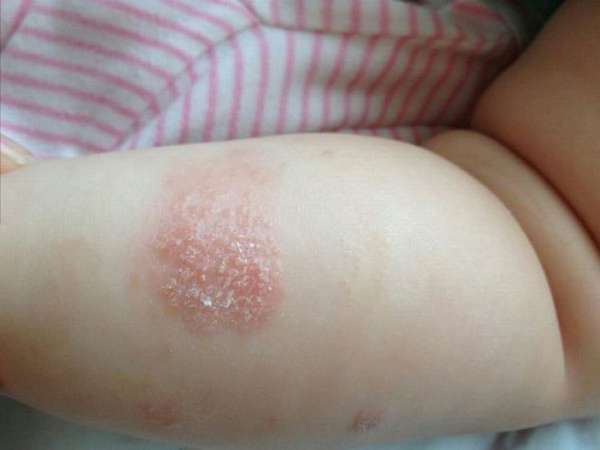 Оджной из причин, почему у новорожденного шелушится и краснеет кожа на теле, может быть атопический дерматит.