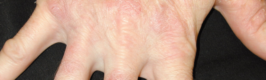 Контактный дерматит фото на руках у детей