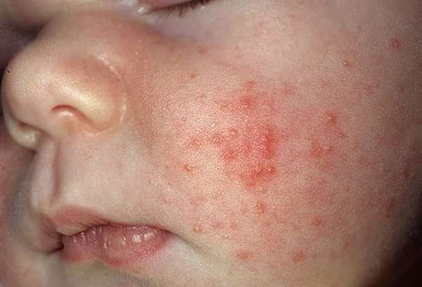Важно также учитывать и то, что нередко лекарства от кашля провоцируют у ребенка аллергию.