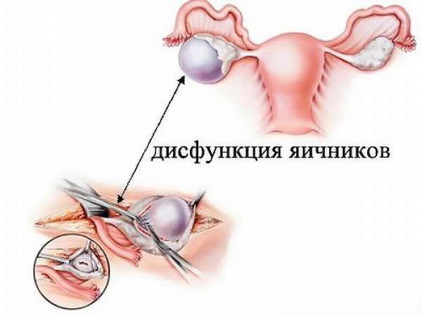 Что такое дисфункция яичников у женщины