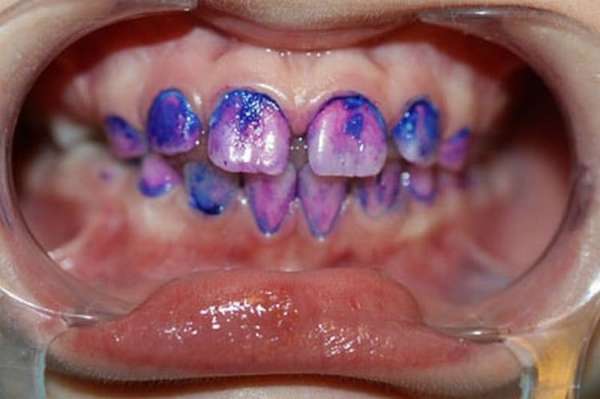 Покрытие зубов серебром детям позволяет сохранить их практически до смены на постоянные.